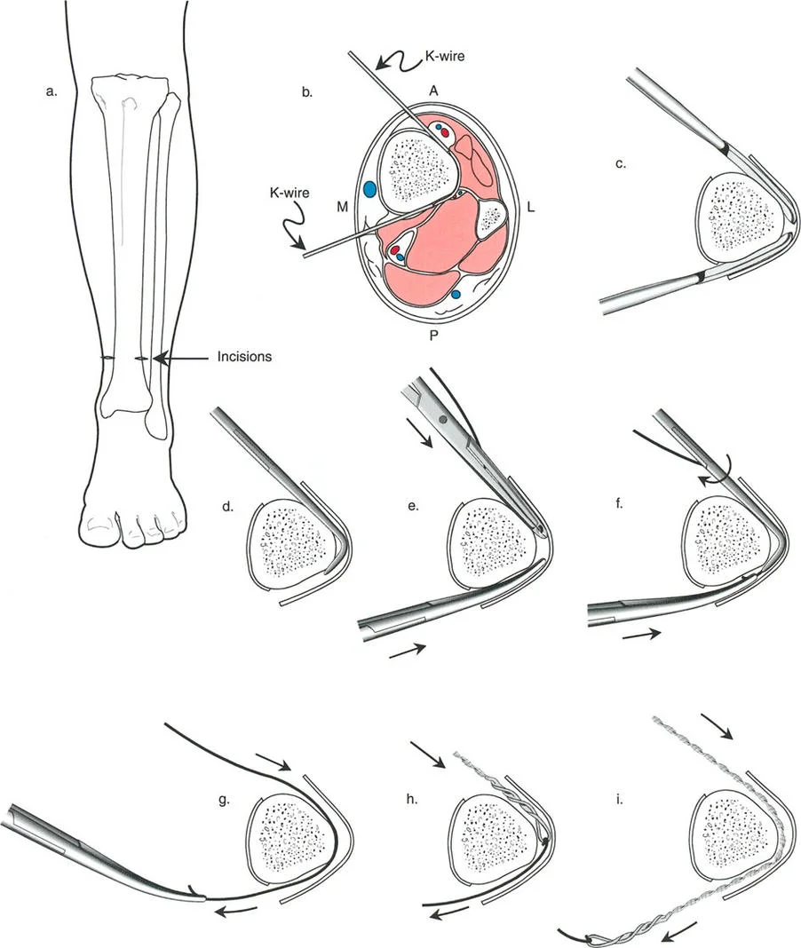 صورة توضيحية لـ تصحيح تشوهات العظام بتقنيات بالي المتقدمة الدليل الشامل للمرضى مع الأستاذ الدكتور محمد هطيف