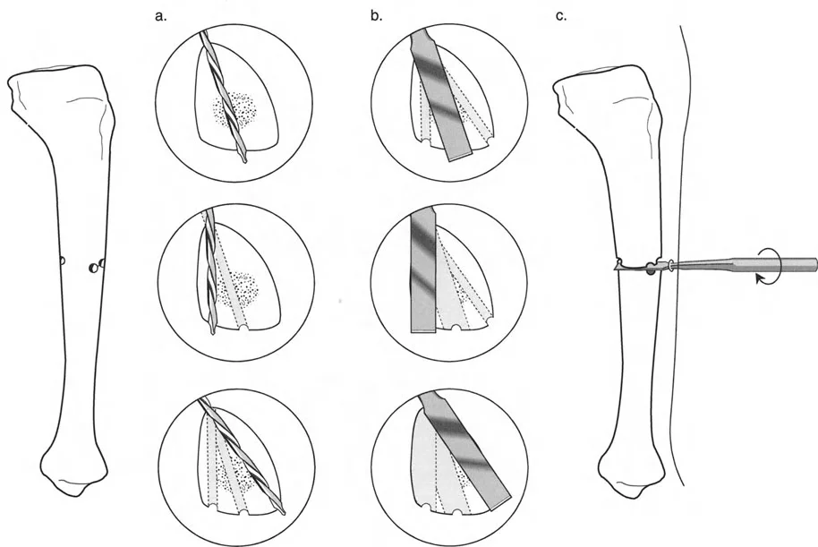 صورة توضيحية لـ تصحيح تشوهات العظام بتقنيات بالي المتقدمة الدليل الشامل للمرضى مع الأستاذ الدكتور محمد هطيف