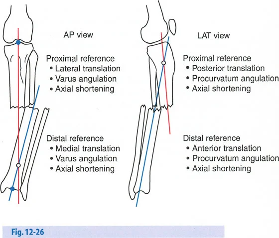صورة توضيحية لتأثير معدل الشد على العظم