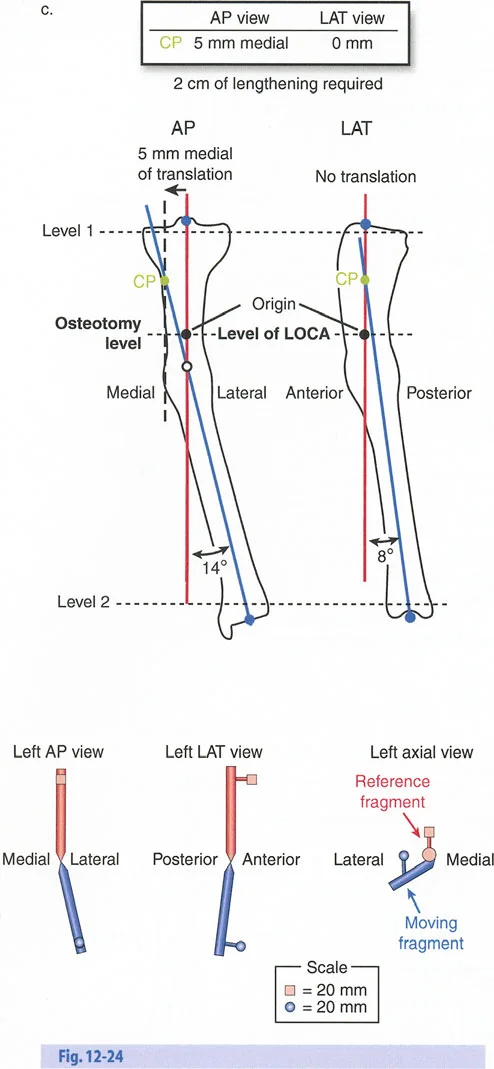 صورة طبية: تصحيح تشوهات العظام بتقنيات بالي المتقدمة الدليل الشامل للمرضى مع الأستاذ الدكتور محمد هطيف