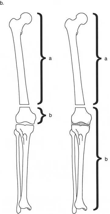 صورة طبية: تصحيح تشوهات العظام بتقنيات بالي المتقدمة الدليل الشامل للمرضى مع الأستاذ الدكتور محمد هطيف