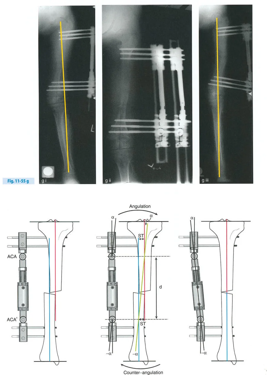صورة طبية: تصحيح تشوهات العظام بتقنيات بالي المتقدمة الدليل الشامل للمرضى مع الأستاذ الدكتور محمد هطيف