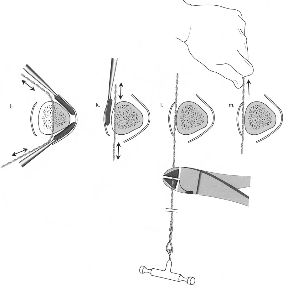 صورة طبية: تصحيح تشوهات العظام بتقنيات بالي المتقدمة الدليل الشامل للمرضى مع الأستاذ الدكتور محمد هطيف