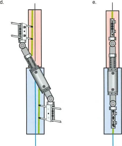 صورة طبية: تصحيح تشوهات العظام بتقنيات بالي المتقدمة الدليل الشامل للمرضى مع الأستاذ الدكتور محمد هطيف