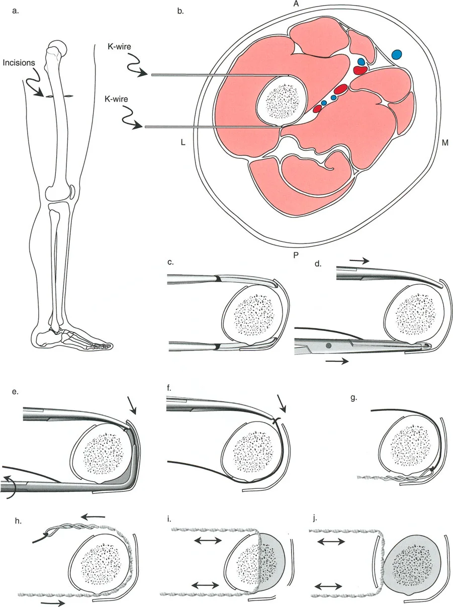صورة طبية: تصحيح تشوهات العظام بتقنيات بالي المتقدمة الدليل الشامل للمرضى مع الأستاذ الدكتور محمد هطيف