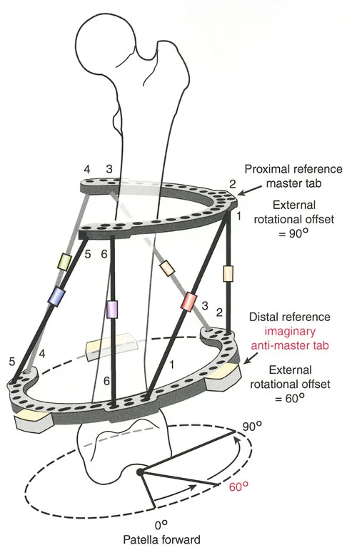 صورة طبية: تصحيح تشوهات العظام بتقنيات بالي المتقدمة الدليل الشامل للمرضى مع الأستاذ الدكتور محمد هطيف