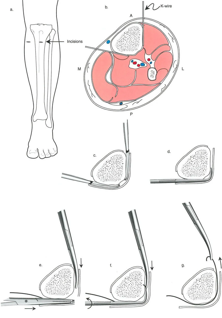 صورة طبية: تصحيح تشوهات العظام بتقنيات بالي المتقدمة الدليل الشامل للمرضى مع الأستاذ الدكتور محمد هطيف