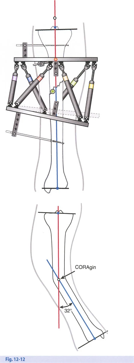 صورة طبية: تصحيح تشوهات العظام بتقنيات بالي المتقدمة الدليل الشامل للمرضى مع الأستاذ الدكتور محمد هطيف