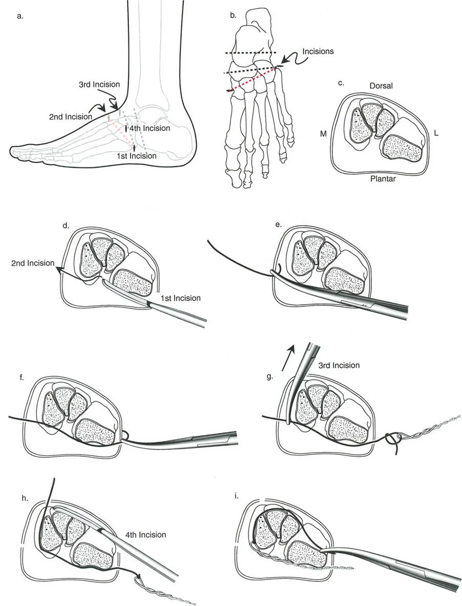 صورة طبية: تصحيح تشوهات العظام بتقنيات بالي المتقدمة الدليل الشامل للمرضى مع الأستاذ الدكتور محمد هطيف