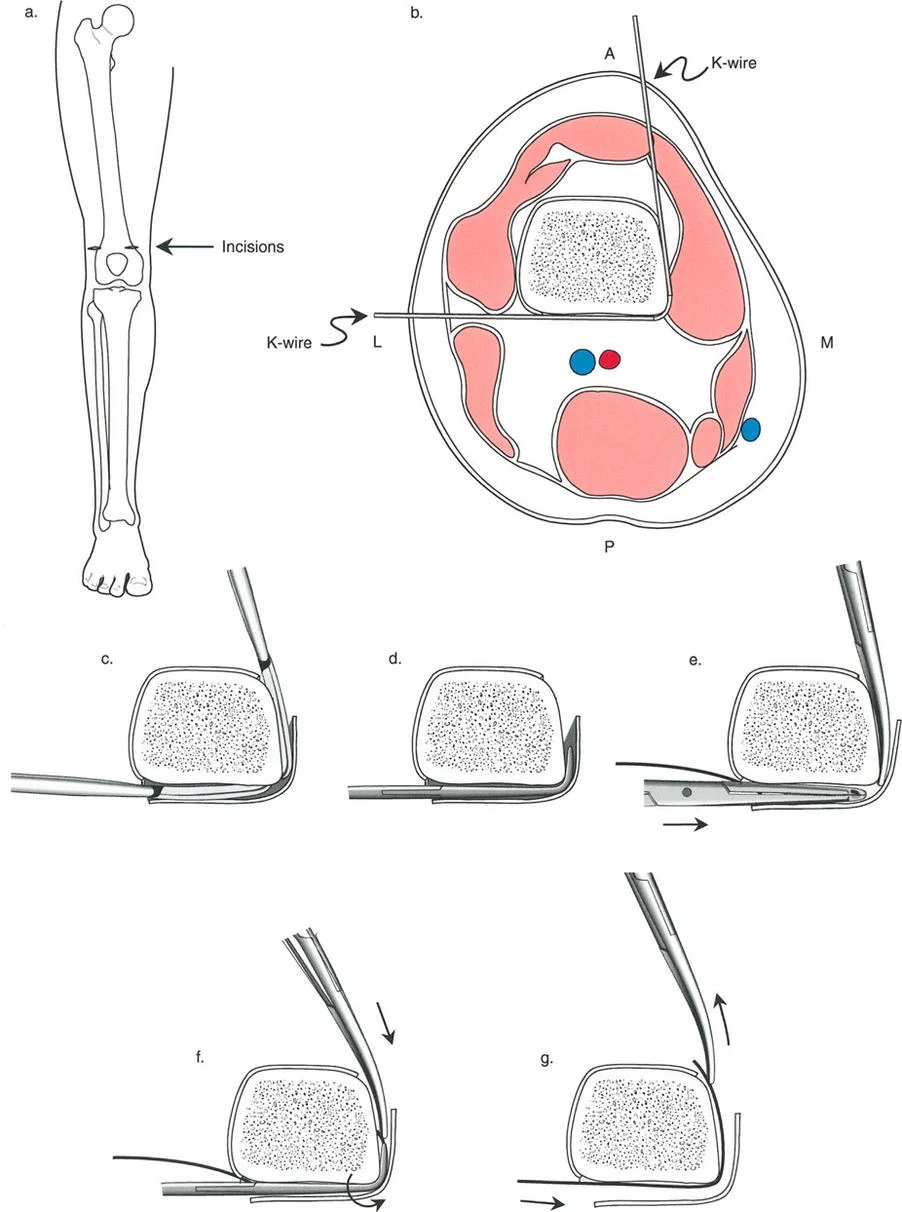 صورة توضيحية لنصائح جراحية للمنشآت القريبة من المفصل