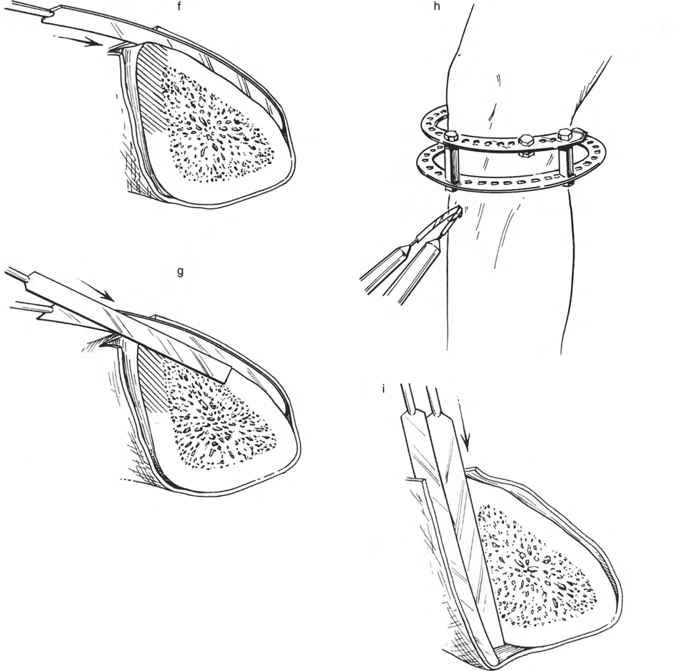 صورة طبية: تصحيح تشوهات العظام بتقنيات بالي المتقدمة الدليل الشامل للمرضى مع الأستاذ الدكتور محمد هطيف