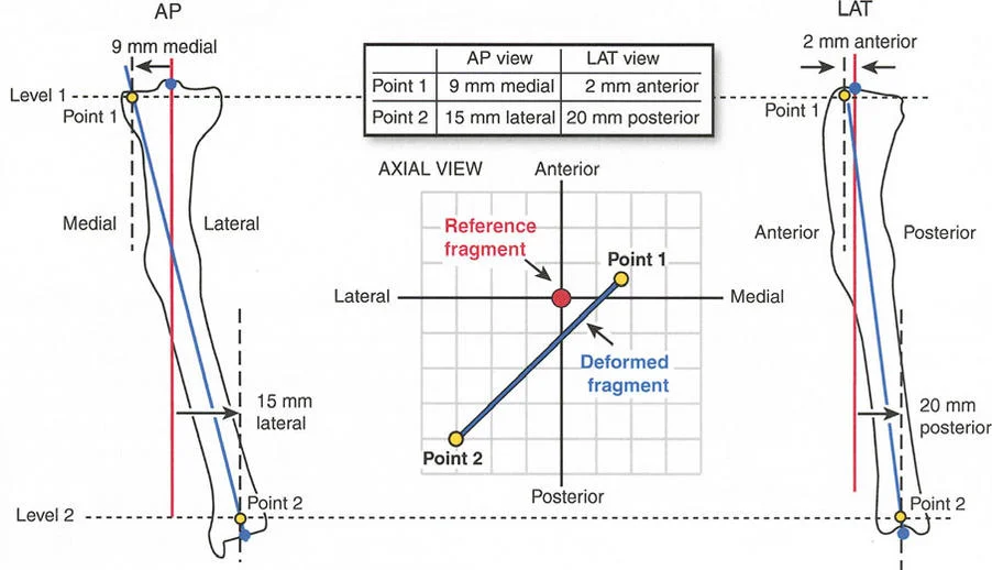 مخطط يوضح مبادئ تصحيح تشوهات العظام