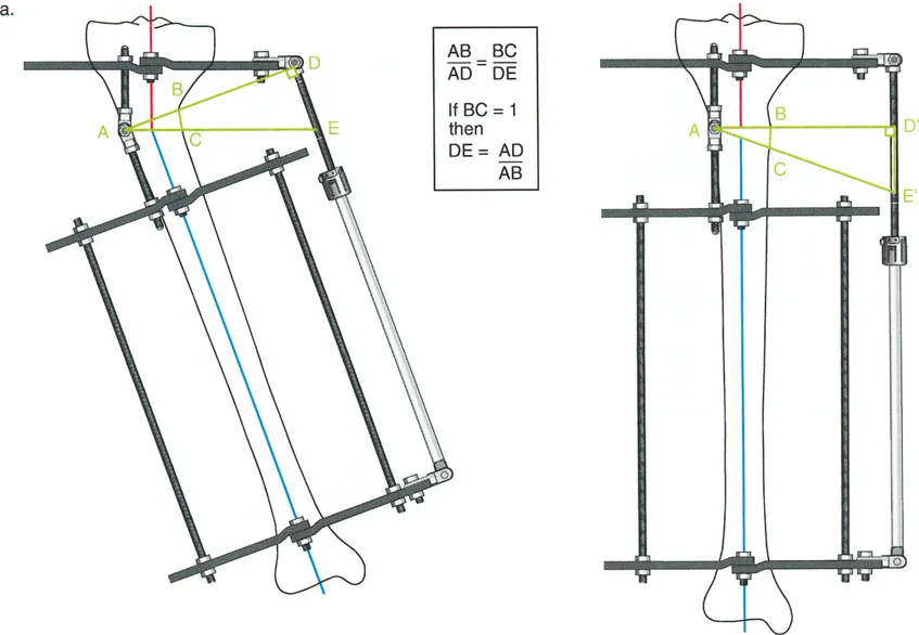 صورة طبية: تصحيح تشوهات العظام بتقنيات بالي المتقدمة الدليل الشامل للمرضى مع الأستاذ الدكتور محمد هطيف