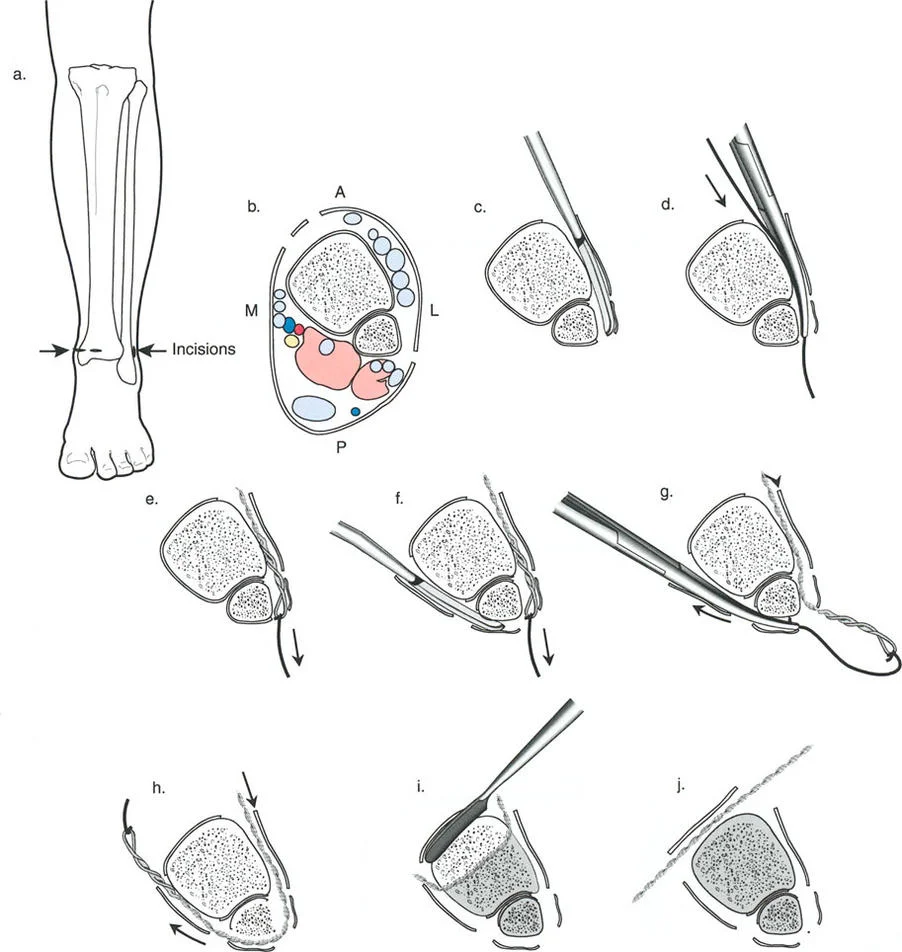 صورة طبية: تصحيح تشوهات العظام بتقنيات بالي المتقدمة الدليل الشامل للمرضى مع الأستاذ الدكتور محمد هطيف