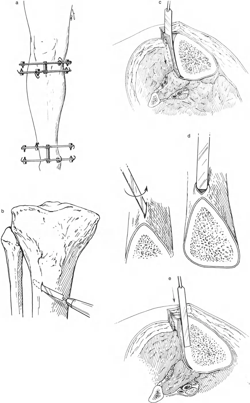 صورة طبية: تصحيح تشوهات العظام بتقنيات بالي المتقدمة الدليل الشامل للمرضى مع الأستاذ الدكتور محمد هطيف
