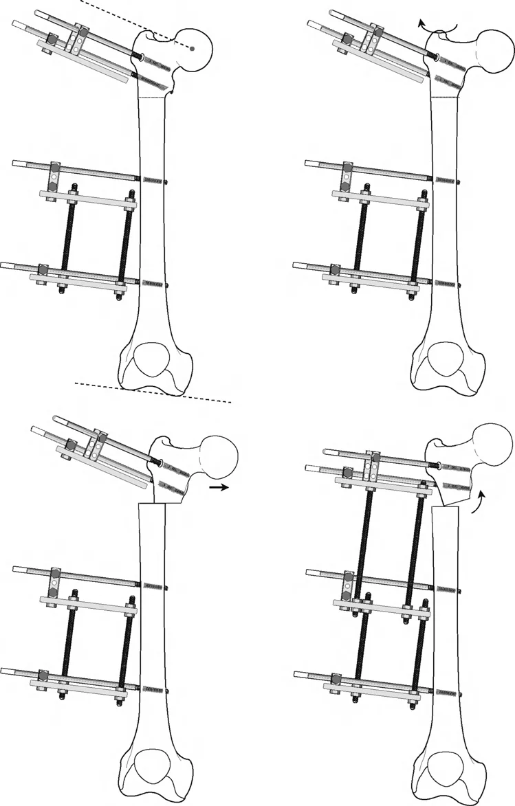 صورة طبية: تصحيح تشوهات العظام بتقنيات بالي المتقدمة الدليل الشامل للمرضى مع الأستاذ الدكتور محمد هطيف