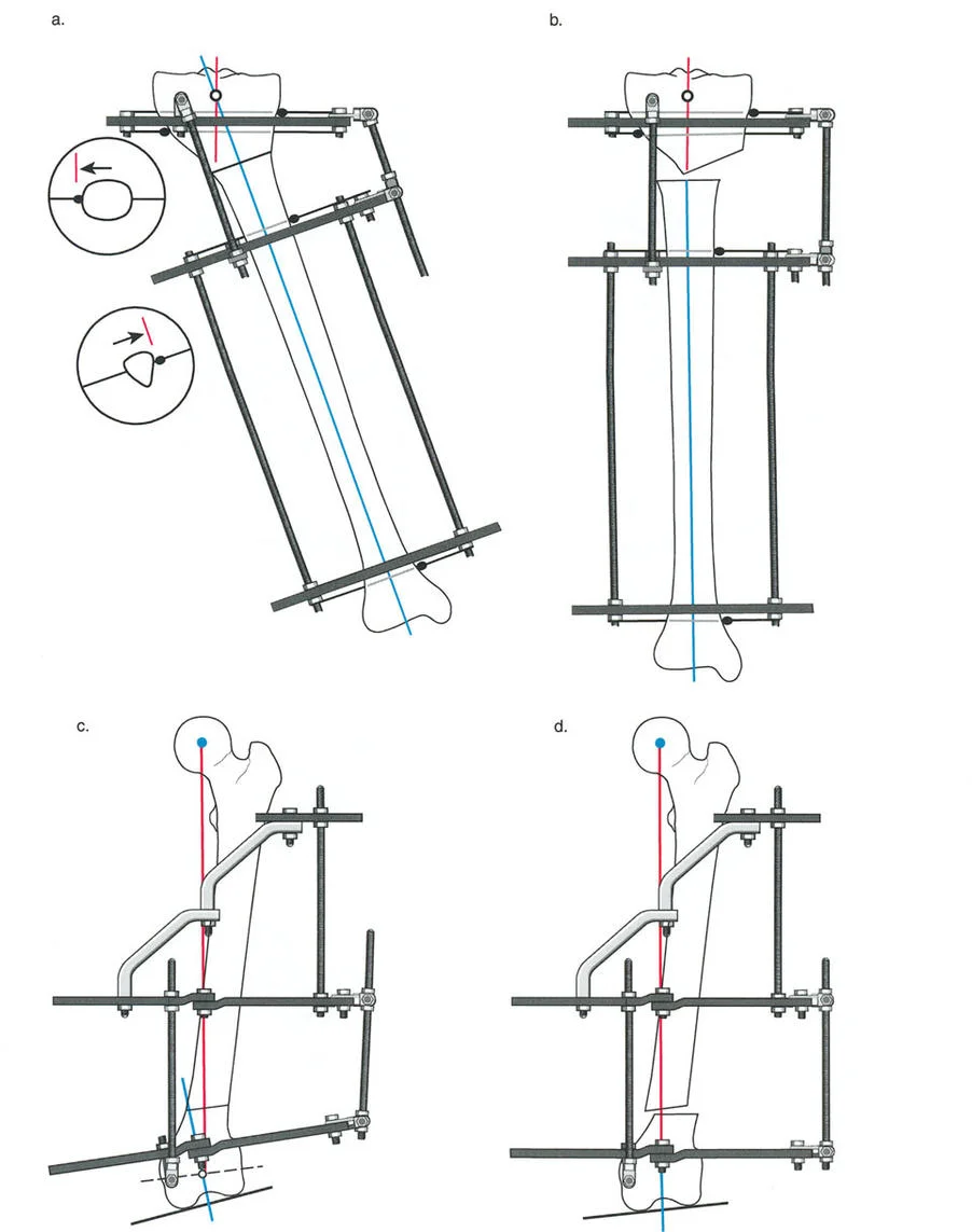 صورة طبية: تصحيح تشوهات العظام بتقنيات بالي المتقدمة الدليل الشامل للمرضى مع الأستاذ الدكتور محمد هطيف