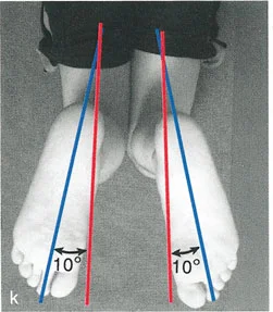 صورة طبية: السيطرة الكاملة على تشوهات العظام المعقدة: تصحيح دقيق بستة محاور مع الأستاذ الدكتور محمد هطيف