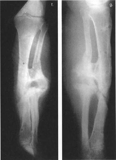 صورة توضيحية لـ السيطرة الكاملة على تشوهات العظام المعقدة: تصحيح دقيق بستة محاور مع الأستاذ الدكتور محمد هطيف