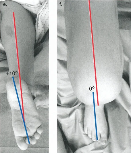 صورة توضيحية لـ السيطرة الكاملة على تشوهات العظام المعقدة: تصحيح دقيق بستة محاور مع الأستاذ الدكتور محمد هطيف