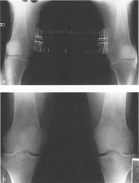 صورة طبية: تقويم تشوهات الأطراف السفلية واختلال المحاذاة: مبادئ بالي وخبرة الأستاذ الدكتور محمد هطيف