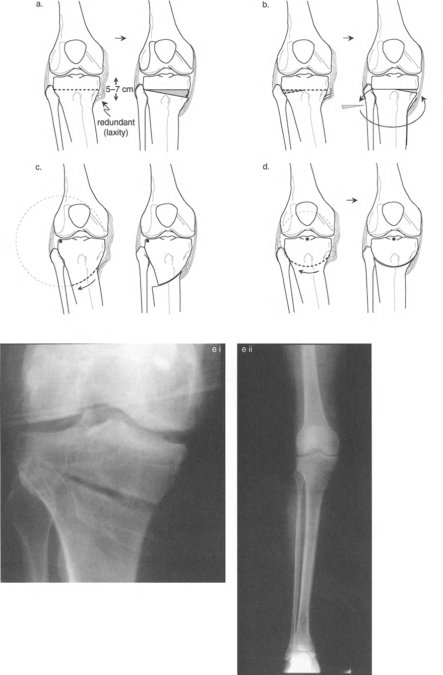 صورة طبية: تقويم تشوهات الأطراف السفلية واختلال المحاذاة: مبادئ بالي وخبرة الأستاذ الدكتور محمد هطيف