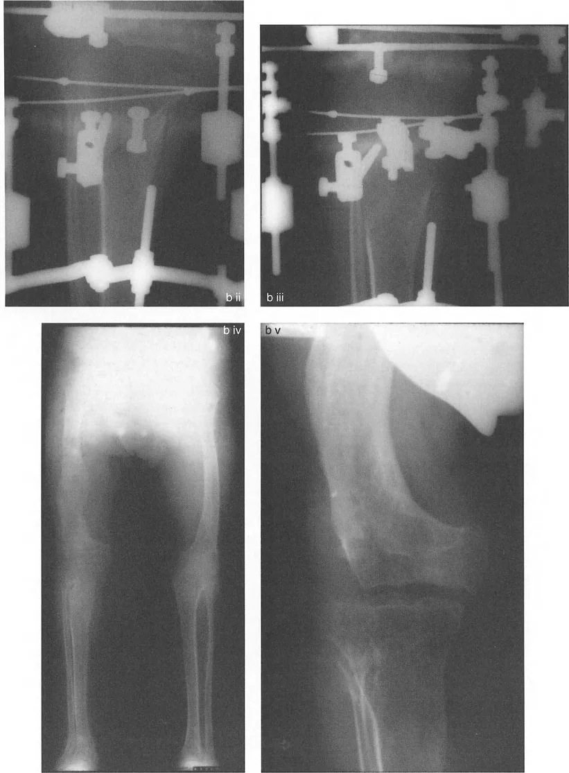 صورة طبية: تقويم تشوهات الأطراف السفلية واختلال المحاذاة: مبادئ بالي وخبرة الأستاذ الدكتور محمد هطيف