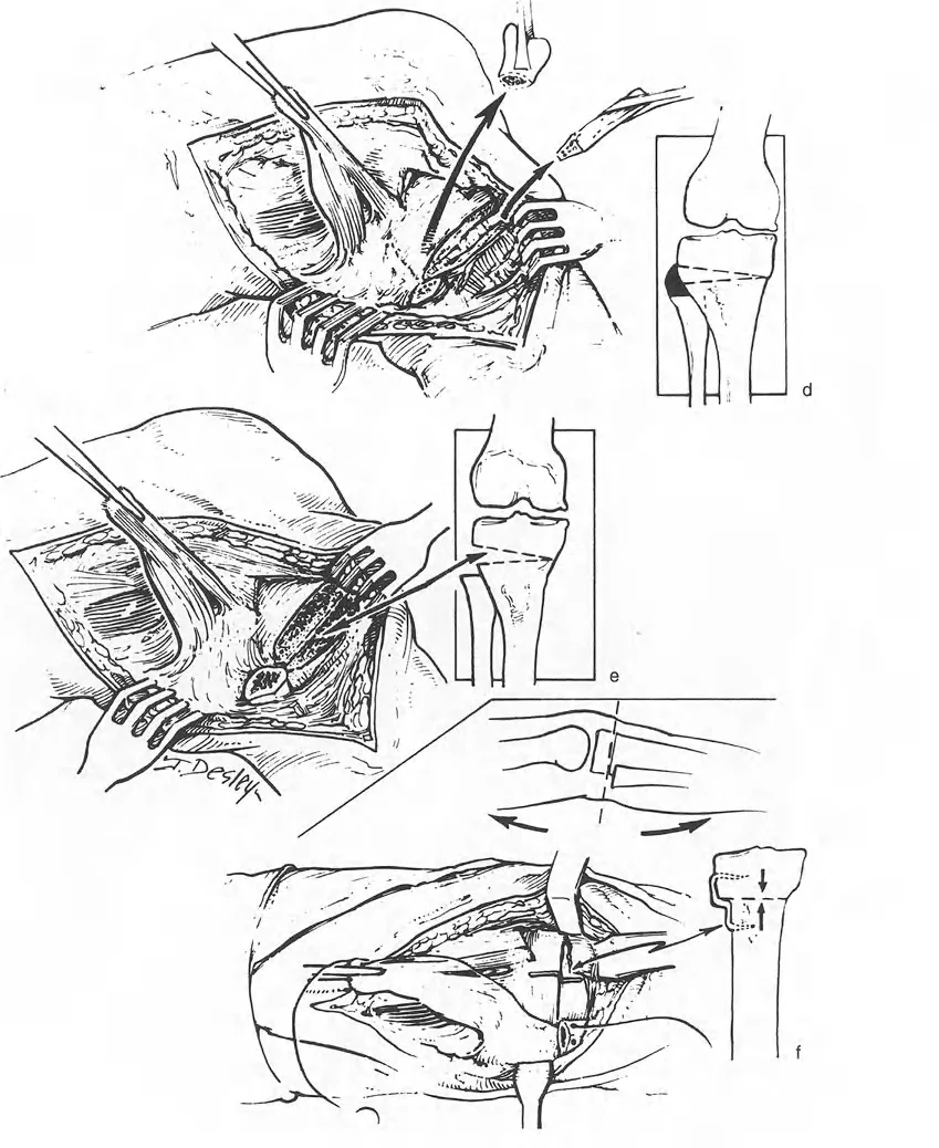 صورة توضيحية لـ تقويم تشوهات الأطراف السفلية واختلال المحاذاة: مبادئ بالي وخبرة الأستاذ الدكتور محمد هطيف