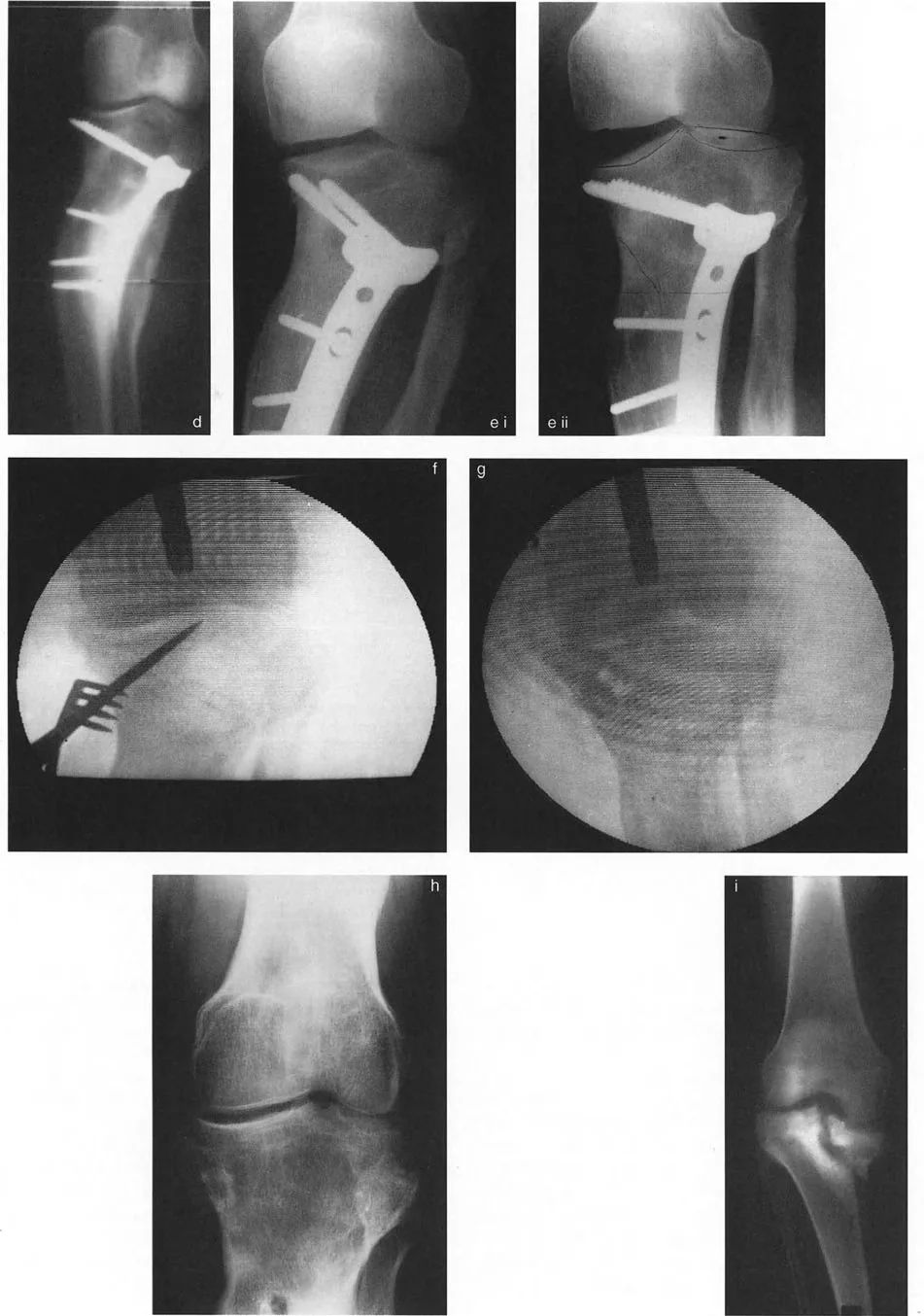 أمثلة كلاسيكية لتشوه خط مفصل الركبة في أمراض مثل بلونت وإليس-فان كريفيلد