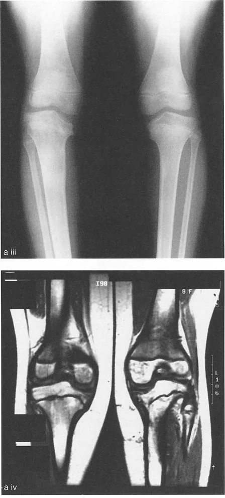 أشعة سينية توضح الفرق بين فقدان الغضروف وارتخاء الأربطة في مفصل الركبة