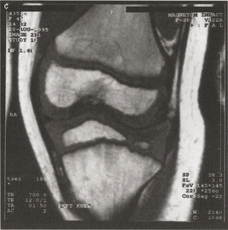 صورة توضيحية لـ تشوه خط مفصل الركبة: دليل شامل للعلاج وإعادة التأهيل مع الأستاذ الدكتور محمد هطيف