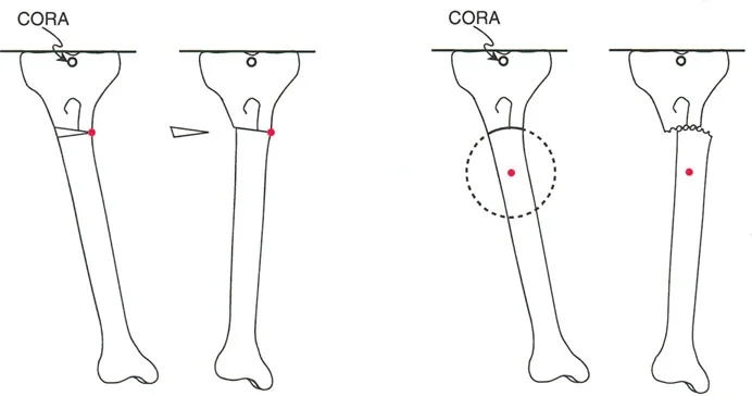 تخطيط جراحي لتصحيح الانحرافات خارج المفصل