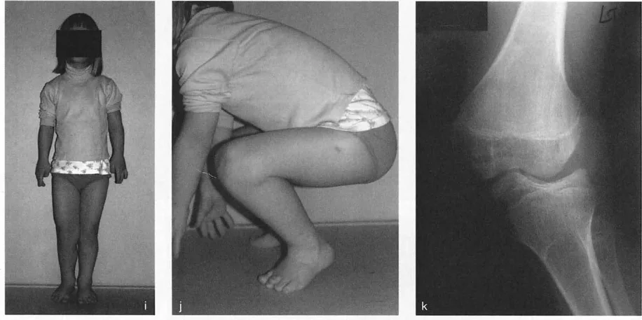 صورة توضيحية للمقارنة بين خط المفصل الوحيد وخطين لتخطيط التصحيح داخل المفصل