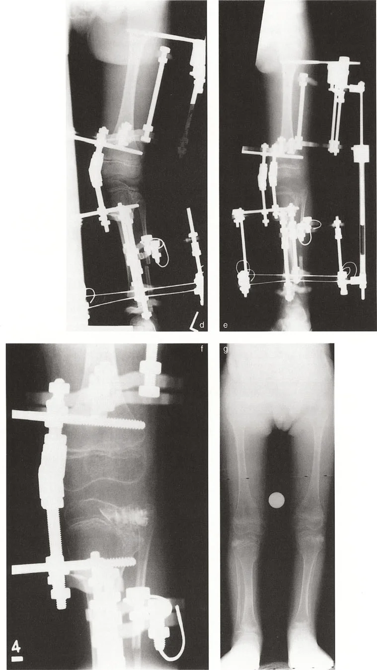 صورة توضيحية لتشوه خط مفصل الركبة الناتج عن خلل التنسج