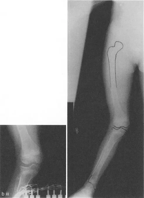 تشوه خط مفصل الركبة: دليل شامل للعلاج وإعادة التأهيل مع الأستاذ الدكتور محمد هطيف