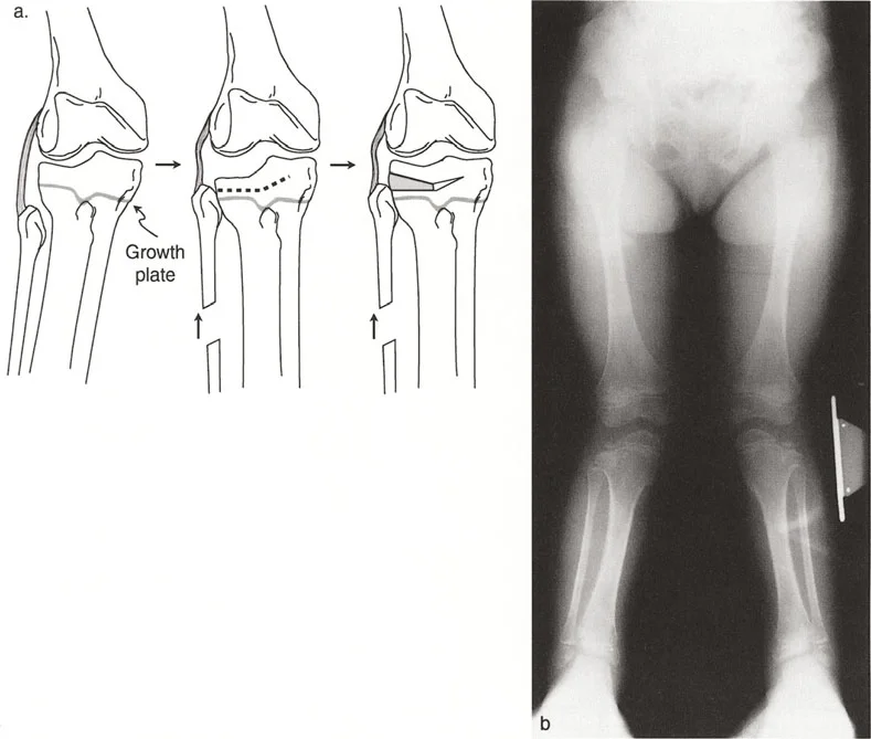 صورة توضيحية لـ تشوه خط مفصل الركبة: دليل شامل للعلاج وإعادة التأهيل مع الأستاذ الدكتور محمد هطيف