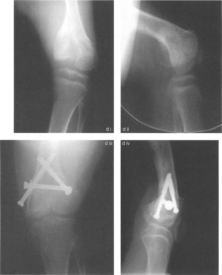 صورة طبية: تشوه خط مفصل الركبة: دليل شامل للعلاج وإعادة التأهيل مع الأستاذ الدكتور محمد هطيف