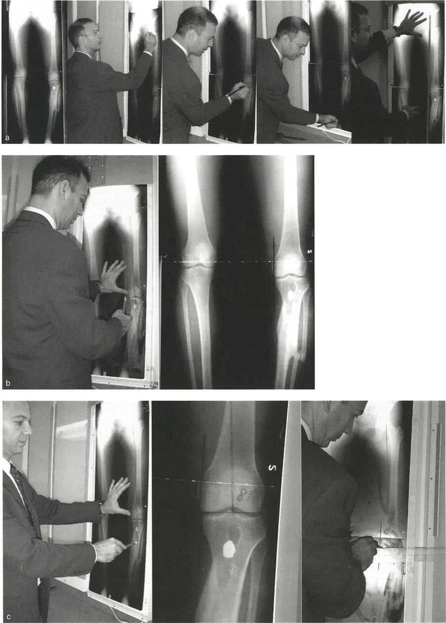 اختلال محاذاة وتشوهات الأطراف السفلية في المستوى الأمامي: دليل شامل من الأستاذ الدكتور محمد هطيف