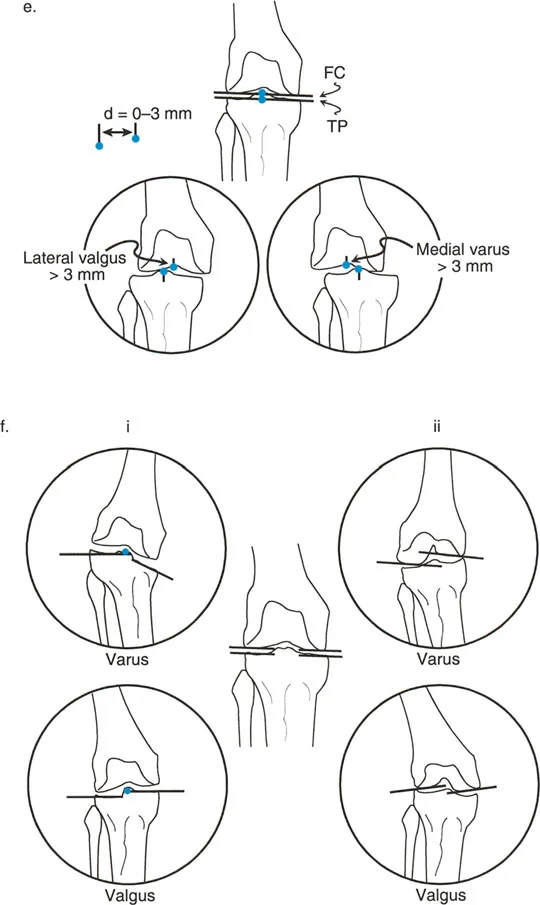 صورة توضيحية لـ اختلال محاذاة وتشوهات الأطراف السفلية في المستوى الأمامي: دليل شامل من الأستاذ الدكتور محمد هطيف
