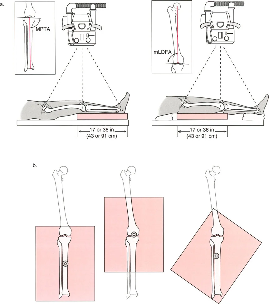 صورة طبية: اختلال محاذاة وتشوهات الأطراف السفلية في المستوى الأمامي: دليل شامل من الأستاذ الدكتور محمد هطيف