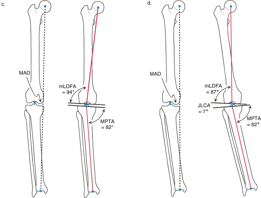 صورة طبية: اختلال محاذاة وتشوهات الأطراف السفلية في المستوى الأمامي: دليل شامل من الأستاذ الدكتور محمد هطيف