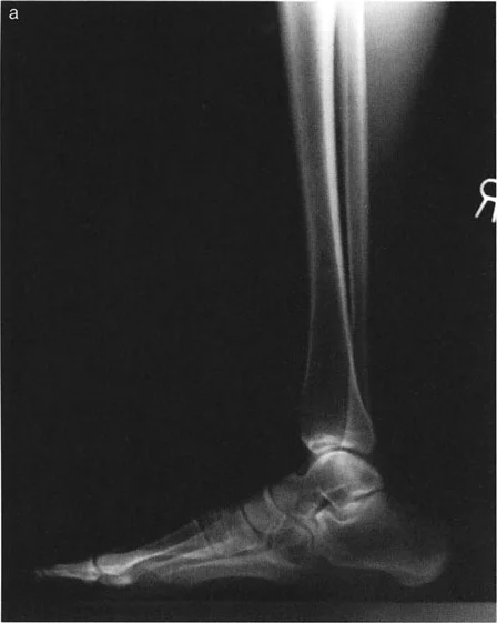 صورة طبية: اختلال محاذاة وتشوهات الأطراف السفلية في المستوى الأمامي: دليل شامل من الأستاذ الدكتور محمد هطيف