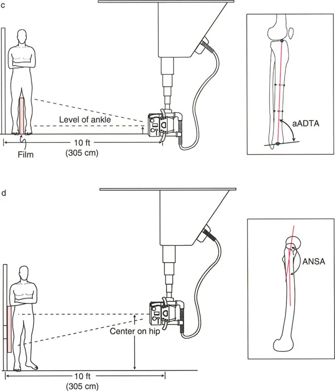 صورة طبية: اختلال محاذاة وتشوهات الأطراف السفلية في المستوى الأمامي: دليل شامل من الأستاذ الدكتور محمد هطيف