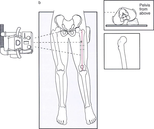صورة طبية: اختلال محاذاة وتشوهات الأطراف السفلية في المستوى الأمامي: دليل شامل من الأستاذ الدكتور محمد هطيف