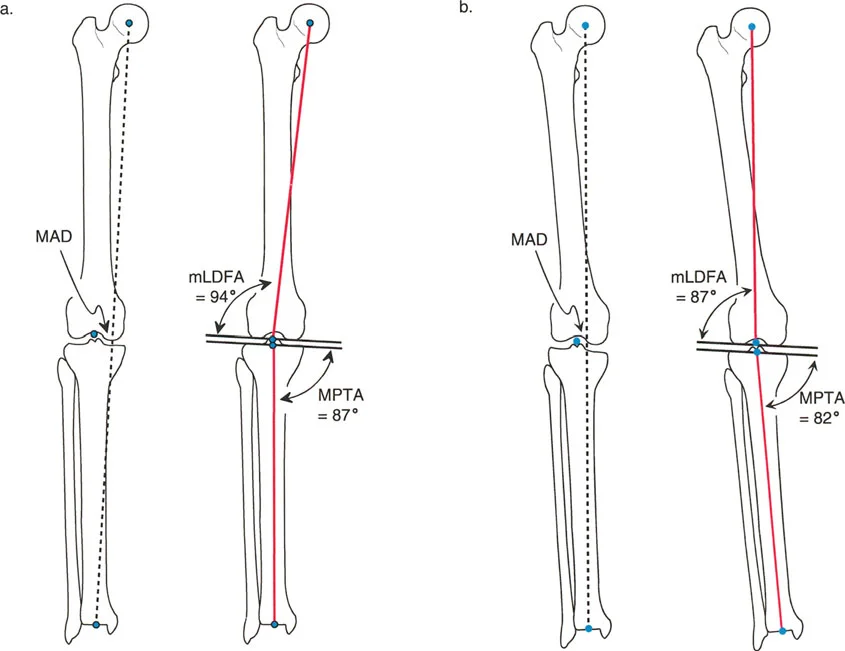 صورة طبية: اختلال محاذاة وتشوهات الأطراف السفلية في المستوى الأمامي: دليل شامل من الأستاذ الدكتور محمد هطيف