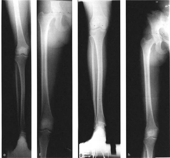 صورة طبية: اختلال محاذاة وتشوهات الأطراف السفلية في المستوى الأمامي: دليل شامل من الأستاذ الدكتور محمد هطيف
