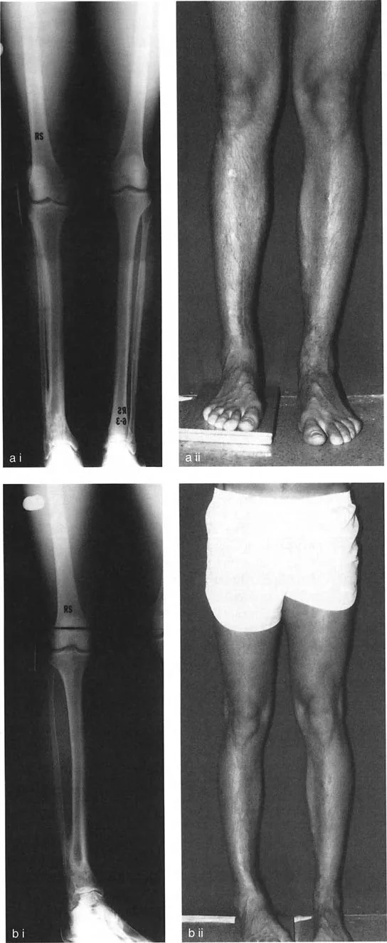 صورة طبية: اختلال محاذاة وتشوهات الأطراف السفلية في المستوى الأمامي: دليل شامل من الأستاذ الدكتور محمد هطيف