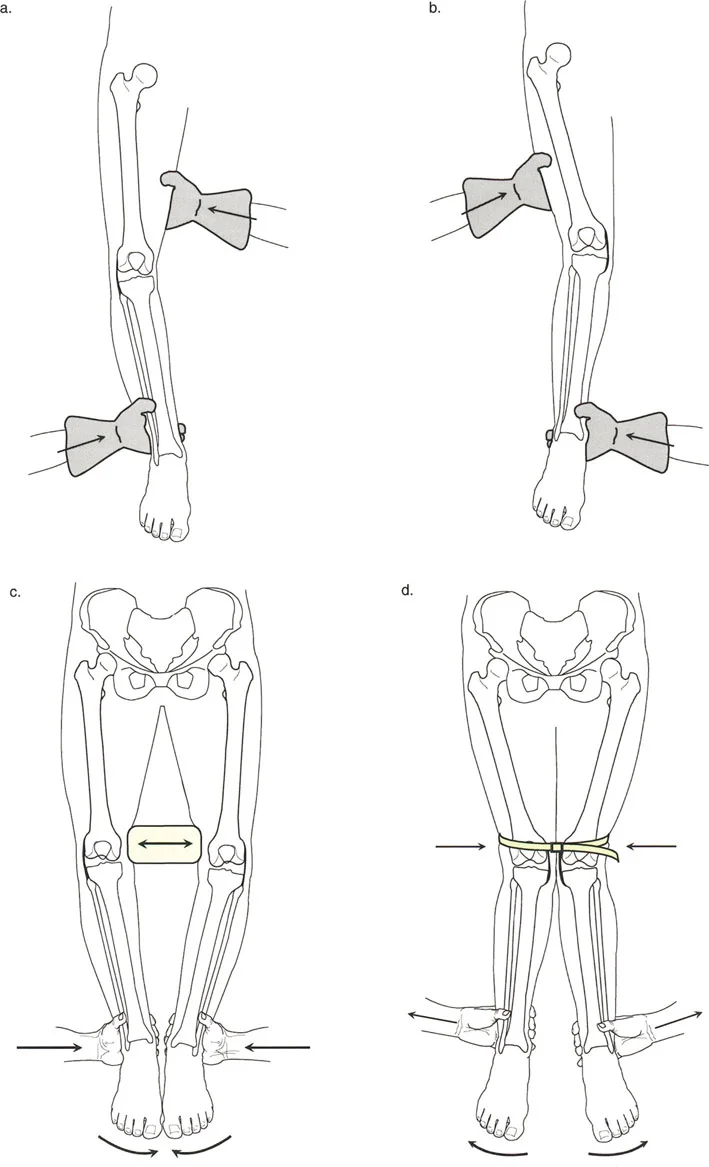 صورة طبية: اختلال محاذاة وتشوهات الأطراف السفلية في المستوى الأمامي: دليل شامل من الأستاذ الدكتور محمد هطيف