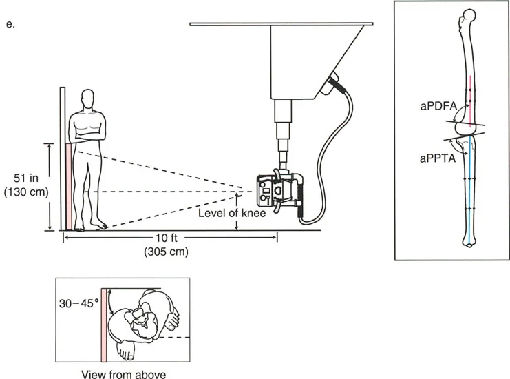 صورة طبية: اختلال محاذاة وتشوهات الأطراف السفلية في المستوى الأمامي: دليل شامل من الأستاذ الدكتور محمد هطيف