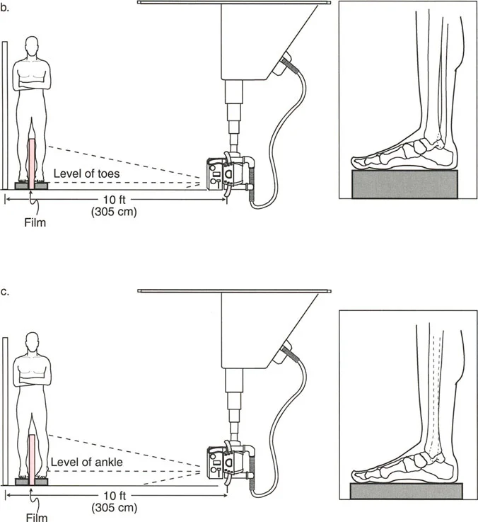 صورة طبية: اختلال محاذاة وتشوهات الأطراف السفلية في المستوى الأمامي: دليل شامل من الأستاذ الدكتور محمد هطيف